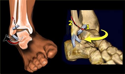 Ankle Avulsion Fracture Treatments and Rehabilitation | New Health Advisor