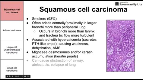 Cancers of the lung - YouTube