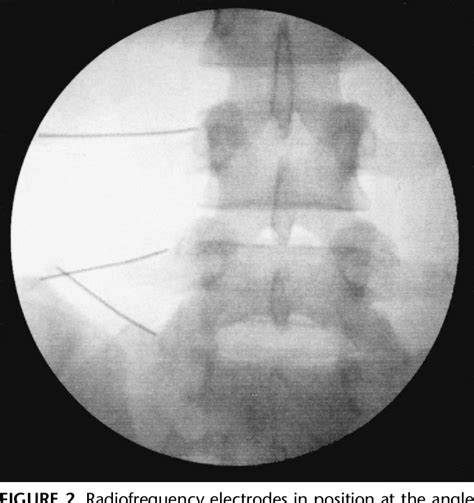 Figure 2 from Radiofrequency denervation of lumbar facet joints in the treatment of chronic low ...