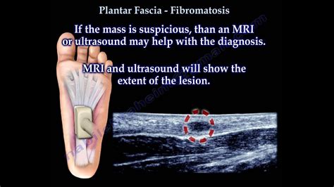 Plantar Fascia ,Plantar Fibromatosis - Everything You Need To Know - Dr. Nabil Ebraheim - YouTube