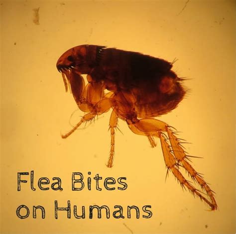 Flea Bites on Humans: Symptoms and Treatment - Dengarden