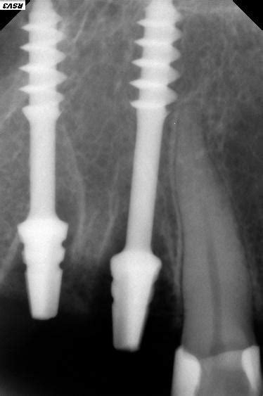 Basal Implants Vs Conventional Dental Implants – Which is the Better Choice?