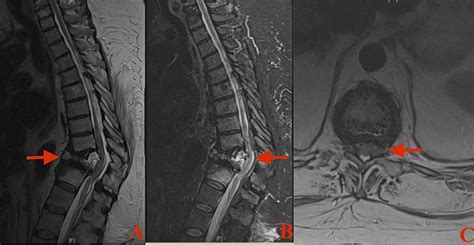 Duplication of Vertebral Pedicles Associated with a Thoracic Burst ...