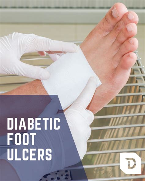 Treatment For Diabetic Ulcers On The Foot Sale Online | emergencydentistry.com