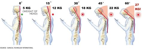 Tech Neck - Ormond Physiotherapy