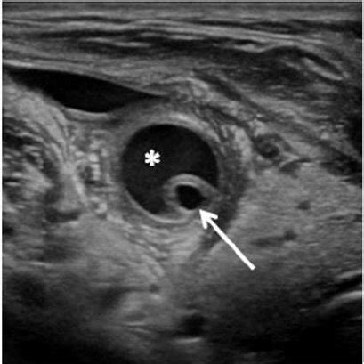 Carotid Siphon Ultrasound