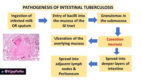 Intestinal Tuberculosis - Pathology Made Simple