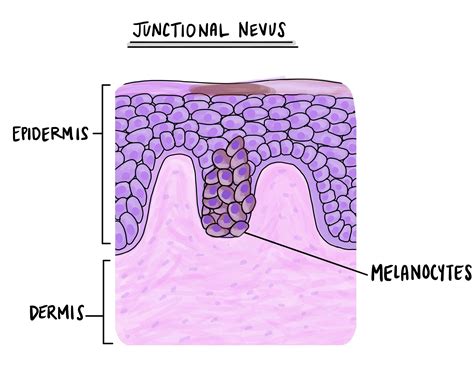 Junctional nevus | MyPathologyReport.ca