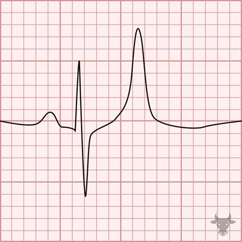 Hypokalemia Hyperkalemia Ecg