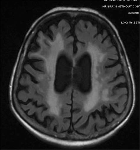 MRI of the head (FLAIR-T2 mode) showing prominent leukoaraiosis in a... | Download Scientific ...