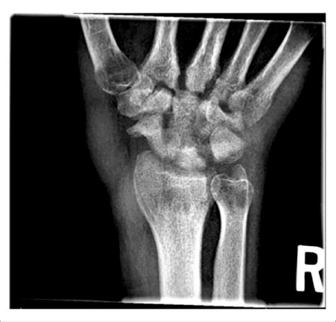 Initial right wrist anteroposterior (AP) radiograph demonstrating... | Download Scientific Diagram