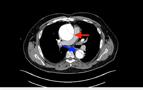 CTA of the chest and abdomen revealing a dissection of the ascending... | Download Scientific ...