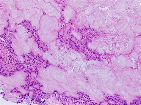 Tophus Histology