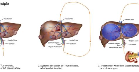 New treatment for patients with rare liver cancer | Health~Holland