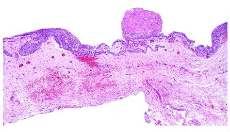 Calcifying odontogenic cyst/calcifying cystic odontogenic tumor: Cyst... | Download Scientific ...