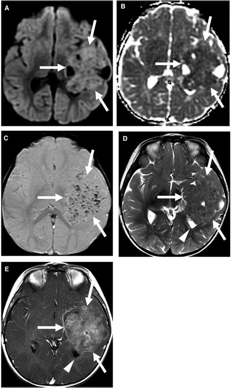 Supratentorial ependymoma, YAP1 fusion-positive. Multiple MRI sequences... | Download Scientific ...