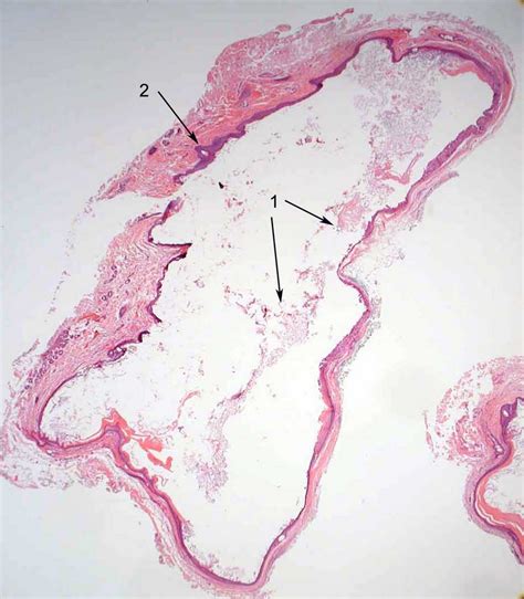 Ocular Pathology: What is a dermoid cyst?