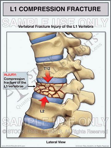 Lumbar Compression Fracture - L1 Vertebral Fracture Trial Exhibit for ...