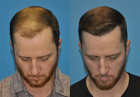 FUE Case Study: 2000 grafts into frontal forelock and hairline ...