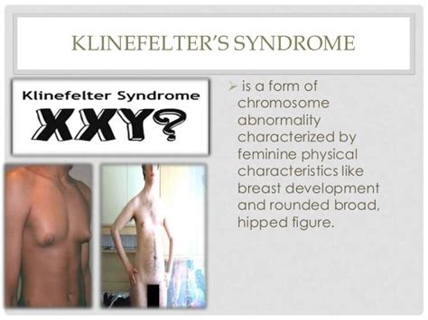 Pervasive developmental disorders (turner syndrome, klinefelter's syn…