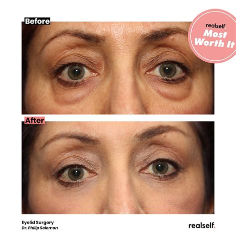 How Long Eyelid Surgery Results Last (and More Answers) | RealSelf | Eyelid surgery, Anti aging ...