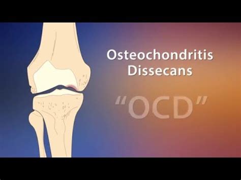 OCD Knee Diagnosis - Scottish Rite for Children Sports Medicine - YouTube