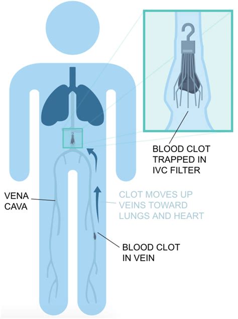 Inferior Vena Cava Filter