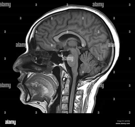 Healthy pineal gland, MRI scan Stock Photo - Alamy