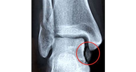 Ankle Avulsion Fracture - Symptoms, Causes & Treatment