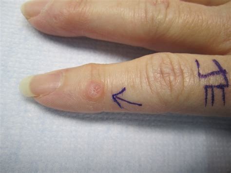 Photos of Mucous Cysts in Fingers - John Erickson, MD