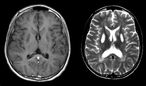 MRI showing bilateral basal ganglia lesions with hypointensity on... | Download Scientific Diagram