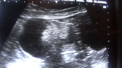 Ovarian Cyst On Ultrasound Image