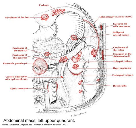 Left Upper Quadrant Pain Causes