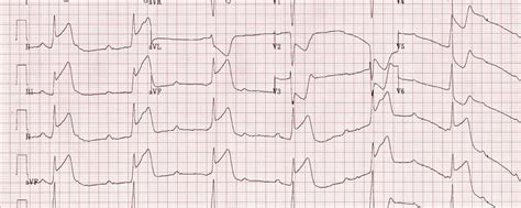 What is a STEMI and how does it look like on a 12 Lead EKG / ECG | Martin Hanzalek