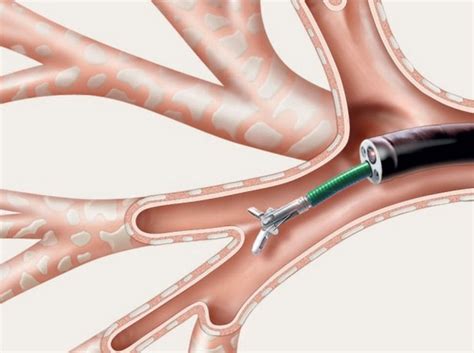 Flexible Bronchoscopy - Pediatric Pulmonologists