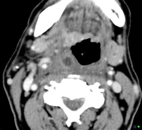 Peritonsillar abscess (quinsy) | Image | Radiopaedia.org