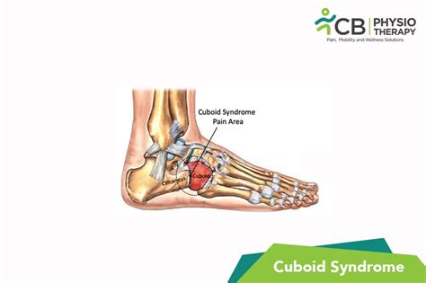 What Is Cuboid Syndrome?, Symptoms, Causes, Diagnosis & Physiotherapy Treatment of Cuboid ...