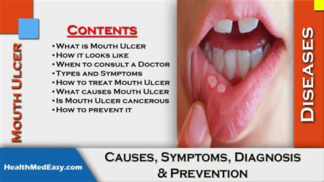 Mouth Ulcer - Causes, Symptoms, Diagnosis, Prevention - HealthMedEasy ...