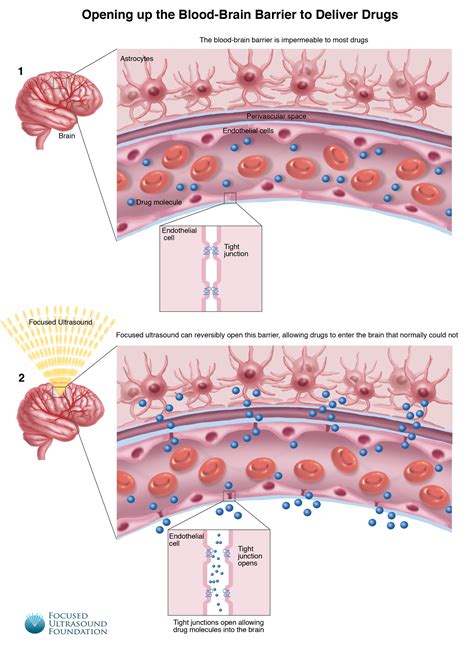 Blood-Brain Barrier Disruption - Focused Ultrasound Foundation