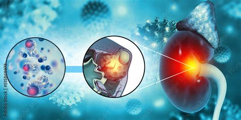 Diagram showing different stages of kidney cancer.3d illustration Stock Illustration | Adobe Stock