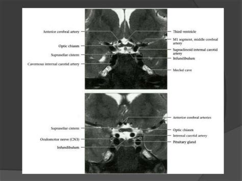 Cranial nerves anatomy & pathology