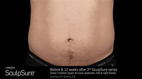 SculpSure Best Fat Removal in San Francisco.