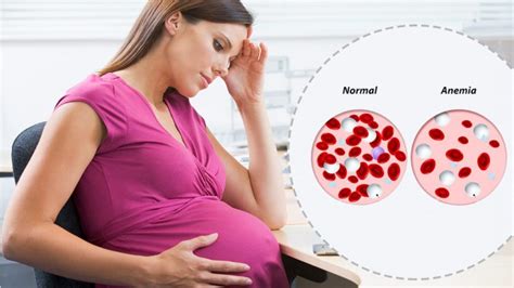 THIS IS WHY PREGNANT WOMEN HAVE ANAEMIA | HealthGist.Net