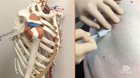 Subacromial Injection | Epomedicine