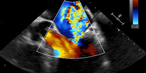 TOE (TransOesophageal Echocardiogram) - HeartWest