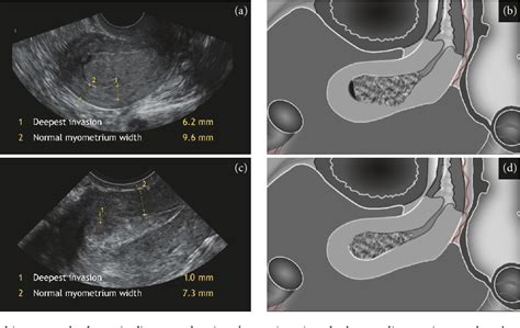 Uterine Cancer Ultrasound