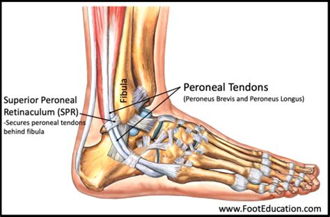 Chronic Peroneal Tendon Subluxation - FootEducation