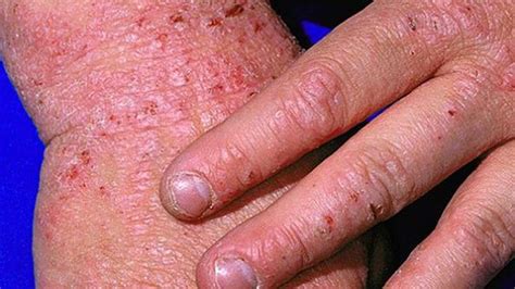 Types of Eczema: Identification, Pictures, and More