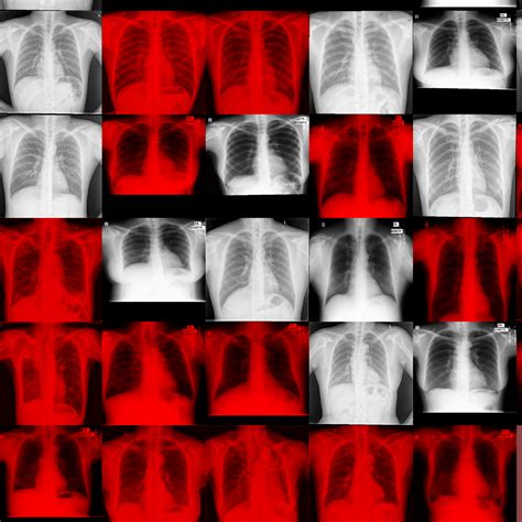 Pulmonary Chest X-Ray Abnormalities | Kaggle