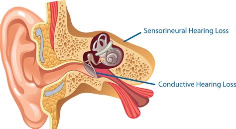 Types of Hearing Loss - The Medical Centre Hearing Services